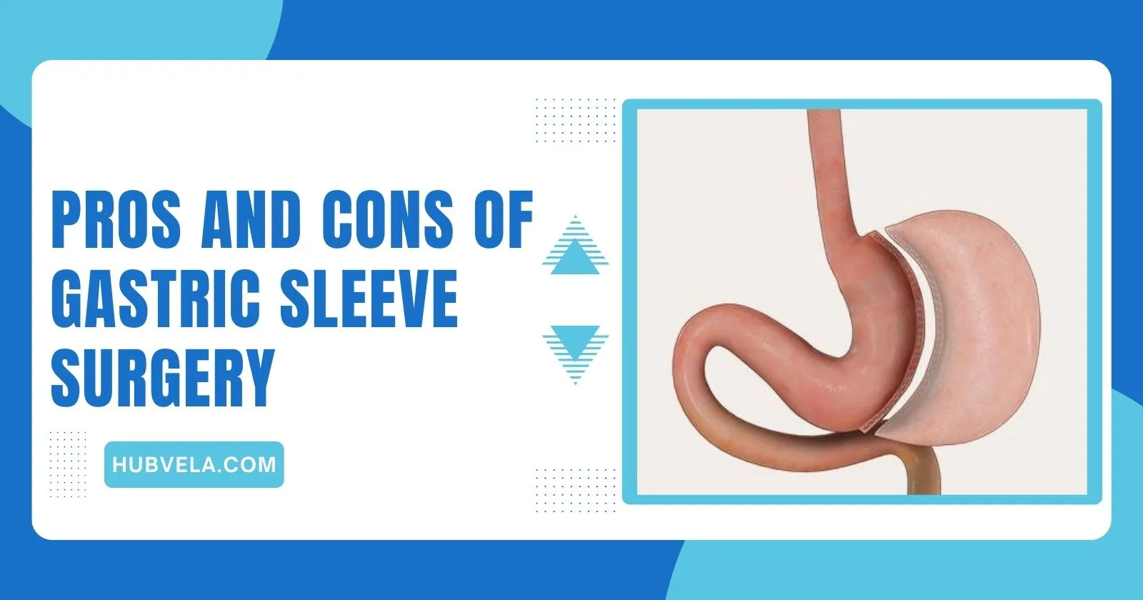 10+ Pros and Cons Of Gastric Sleeve Surgery » Hubvela